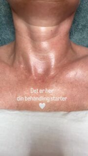 Der er er en grund til, at jeg altid starter mine behandlinger her… 🤍

Mine behandlinger skal selvfølgelig være effektive, føles behagelige og give ro til både krop og nervesystem.

Men der ligger også en faglig intention bag hver eneste teknik jeg benytter 🤍

Hvert produkt.
Hver massage-tag. 
Hver Gua Sha-strøg. 
Hvert akupressur punkt. 
Og i de første blide strøg ved halsen og kravebenene.

Når jeg arbejder med huden, arbejder jeg ikke kun på overfladen. 
Under huden findes et fascinerende samspil mellem muskler, bindevæv, blodkar og lymfesystem, som alle har betydning for hudens udseende og velvære 🤍

Området omkring kravebenene er en vigtig del af lymfesystemets naturlige afløb. 
Derfor starter jeg altid her, så jeg understøtter kroppens egne processer, før jeg arbejder videre op i ansigtet med kosmetisk akupunktur, ansigtsbehandling eller Japansk Lifting.

For mig handler hudpleje om meget mere end produkter.

Det handler om at forstå huden, kroppen og de processer, der foregår under overfladen – og om at arbejde med dem frem for imod dem 🤍

Du kan se videoer på min hjemmeside hvor jeg viser teknikker til Lymfedrænage, eller booke en tid til behandling hvor det, naturligvis, er en del af behandlingen.
Jeg vejleder altid meget gerne hvordan du kan gøre derhjemme selv 🤍

Kærlig hilsen - og nyd din sommer 🤍

Anja
AM Beauty & care
.
.
.
.
#lymfedrænage #akupunktur #ansigtsbehandling #japansklifting holistisk